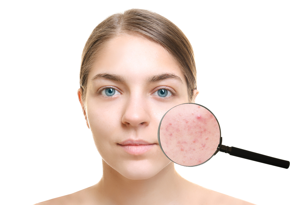 Treatment of acne in Kabul