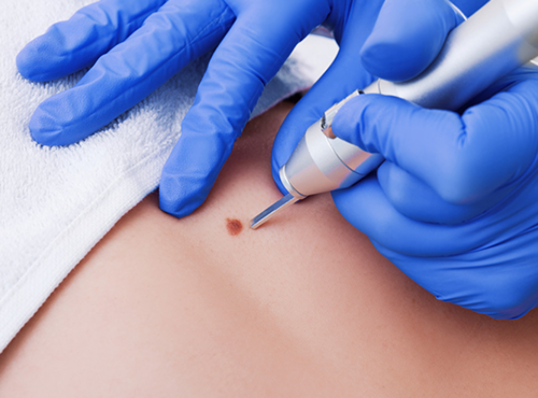Removing Moles with Laser 