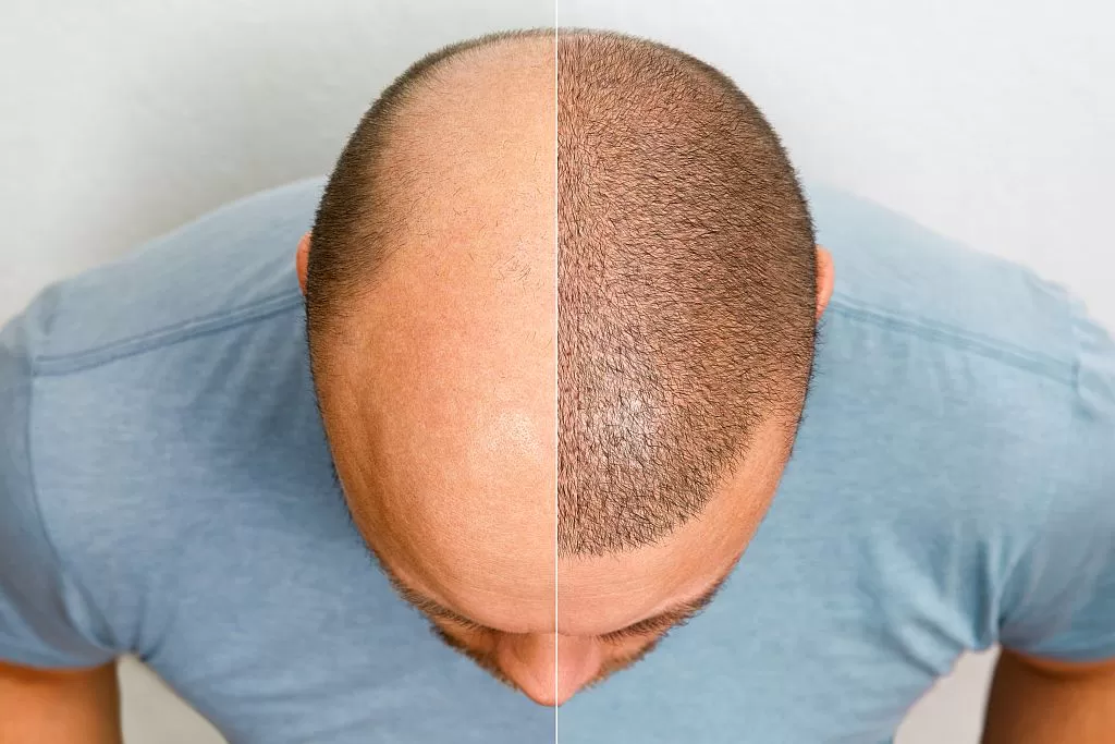 HAIR TRANSPLANTATION