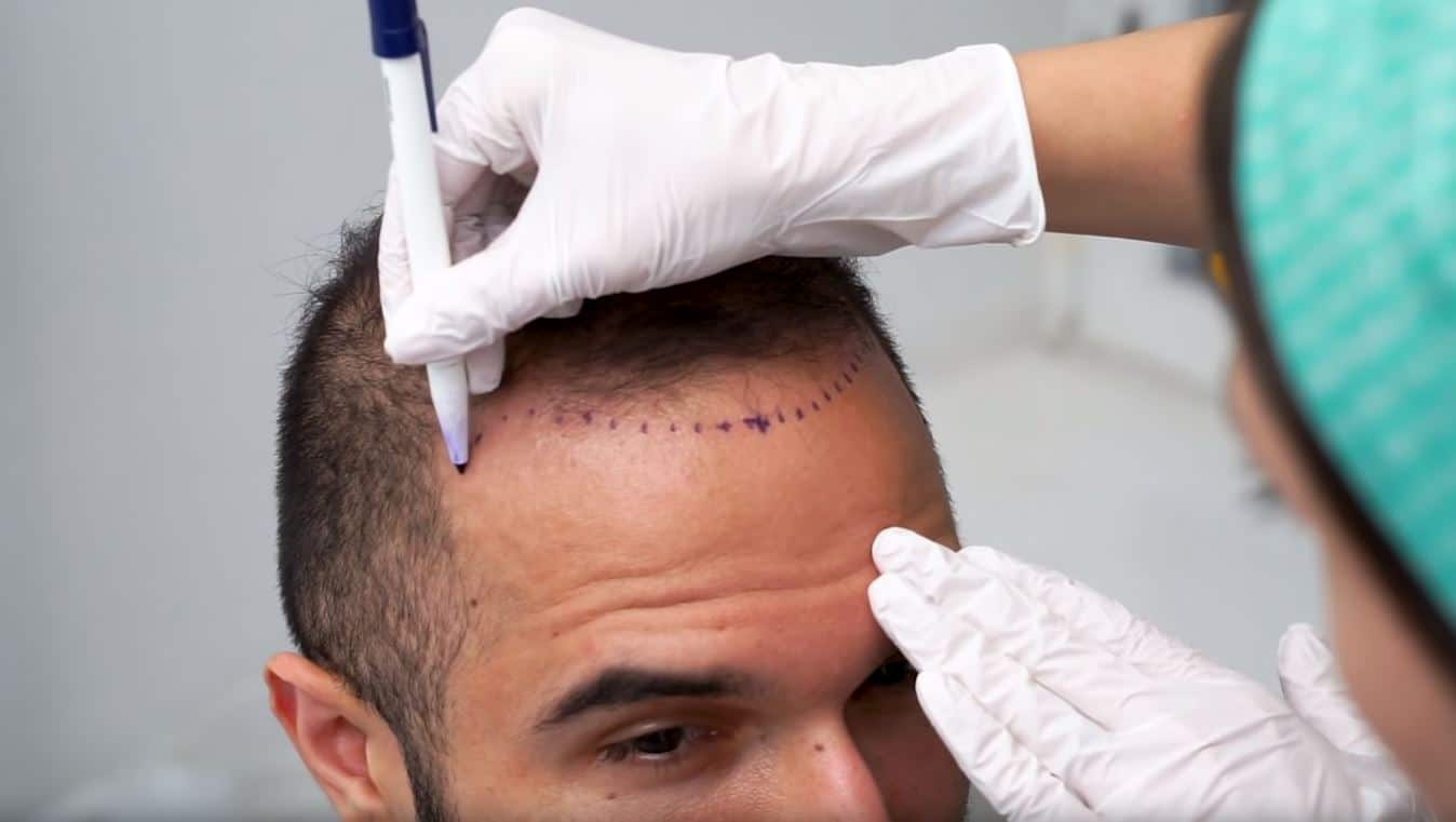 Cost of hair transplantation in Kabul