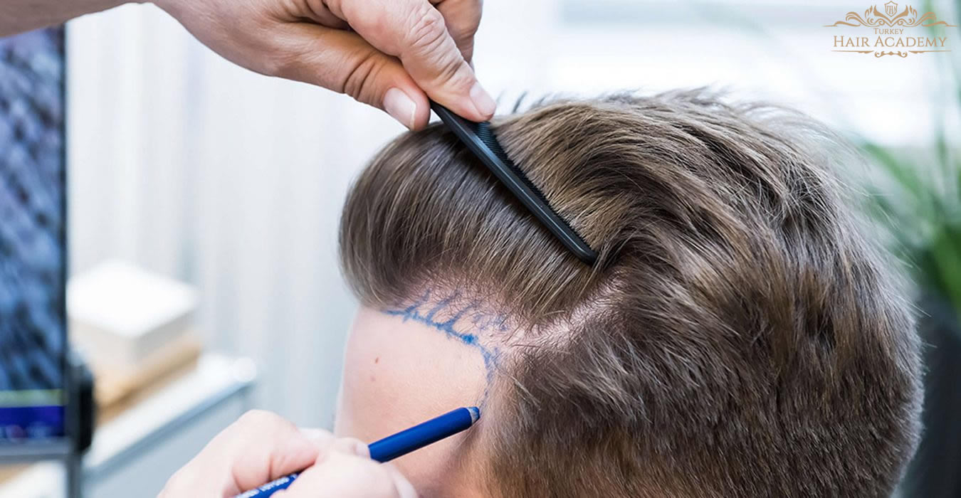 Who is Suitable for a Hair Transplant
