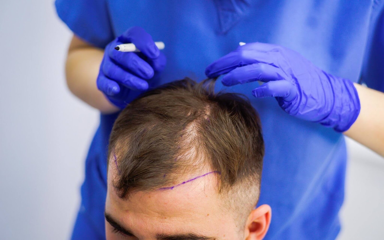 Hair Loss Treatment