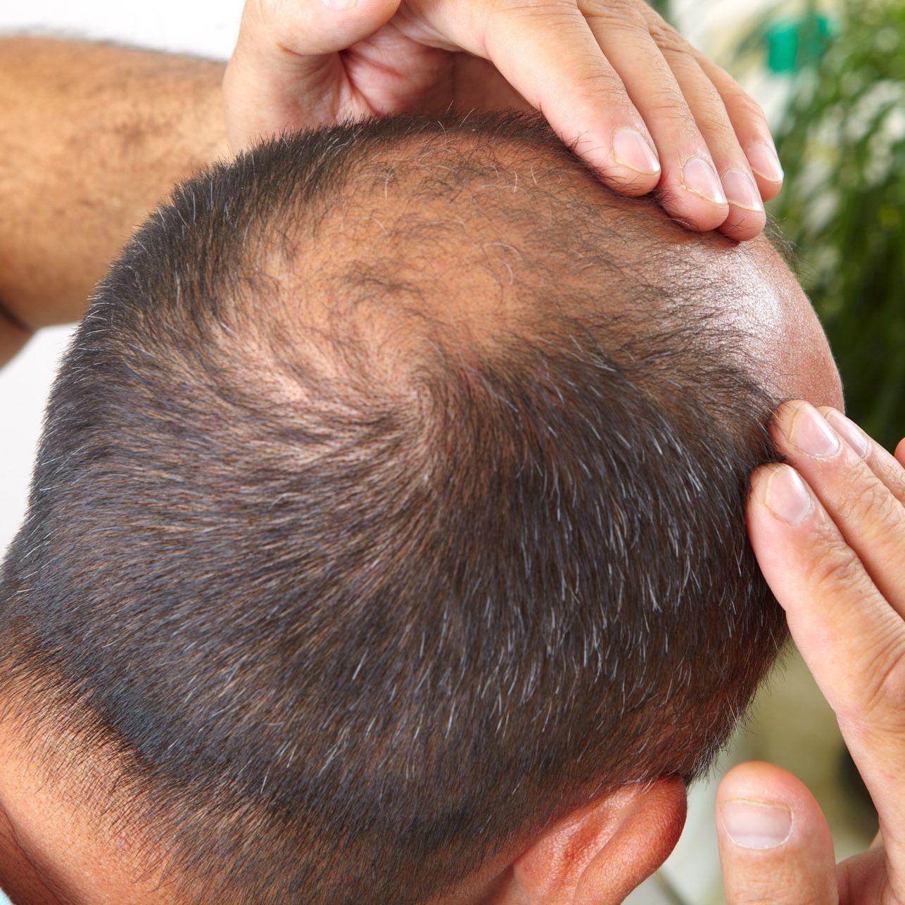  ویښتانو د توییدو درملنې – د آروین د پوستکی په روغتون کی 