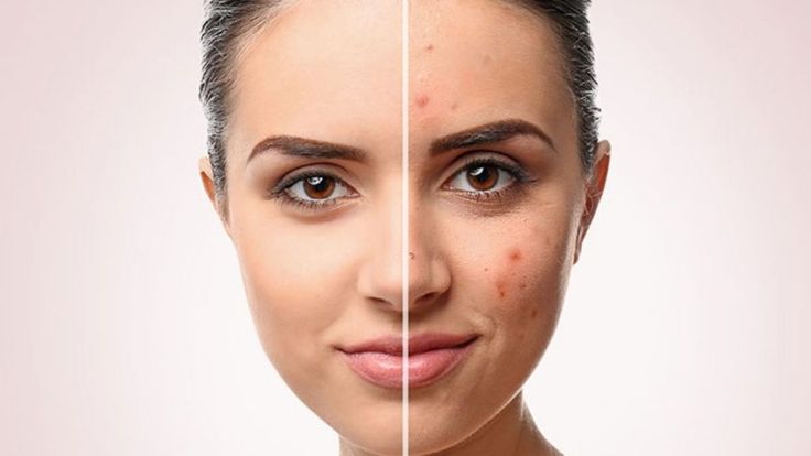 Top 8 Acne Triggers