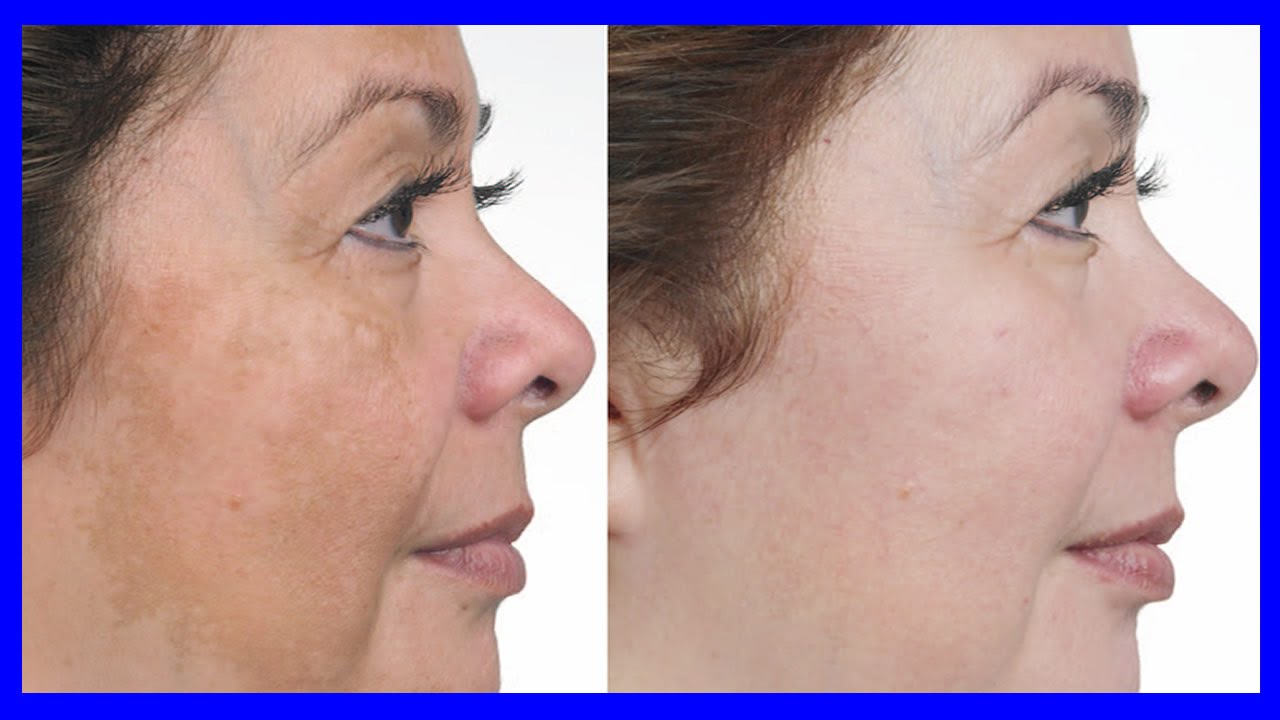 Skin Whitening and Brightening at Arvin Skin Hospital: Achieve Radiant Skin