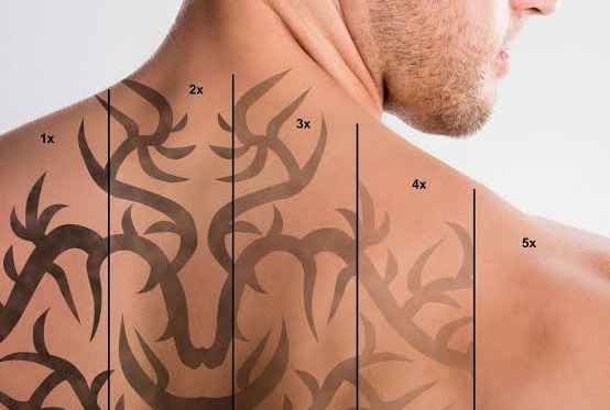 Tattoo Removal at Arvin Dermatology Hospital: Using Pico Laser, the Most Advanced Method for Tattoo Removal