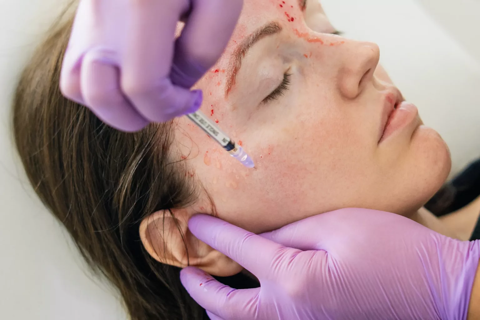 Wrinkle Removal with Botox and Fillers in Kabul