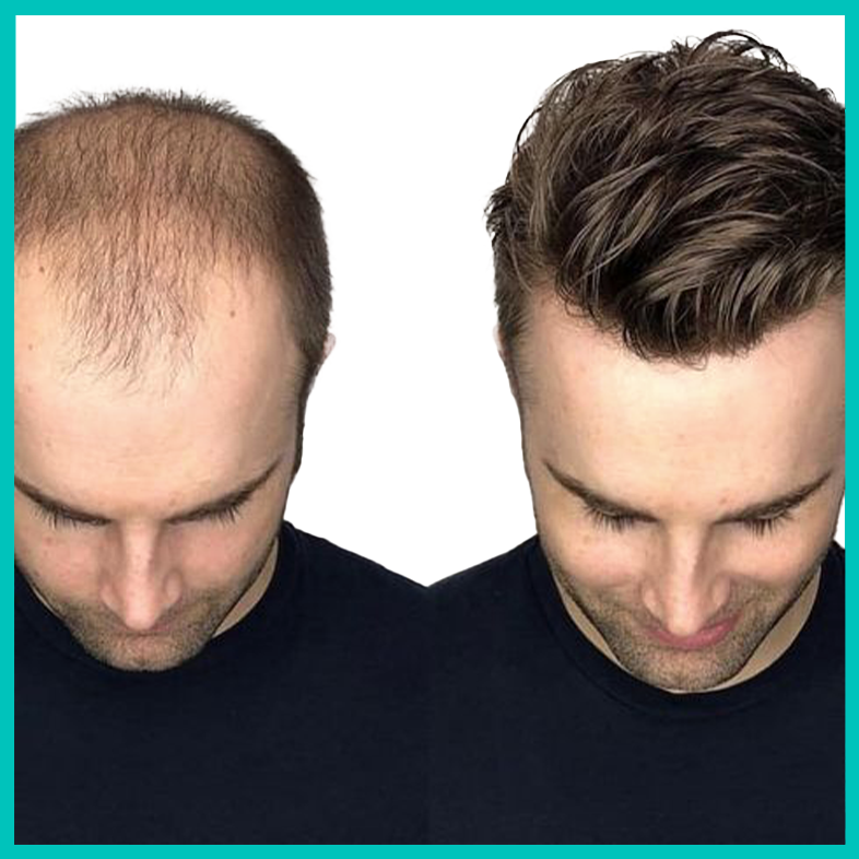 HAIR TRANSPLANTATION