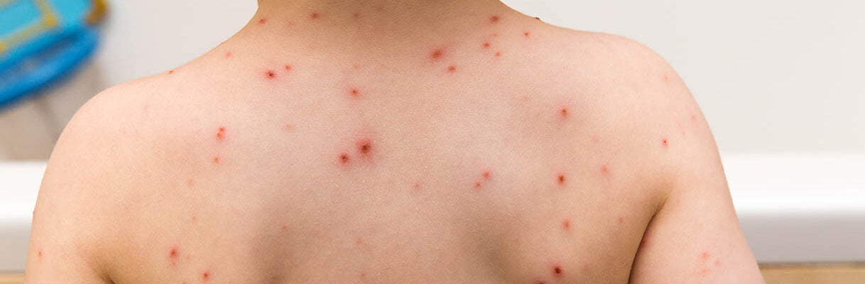 Treatment of varicella