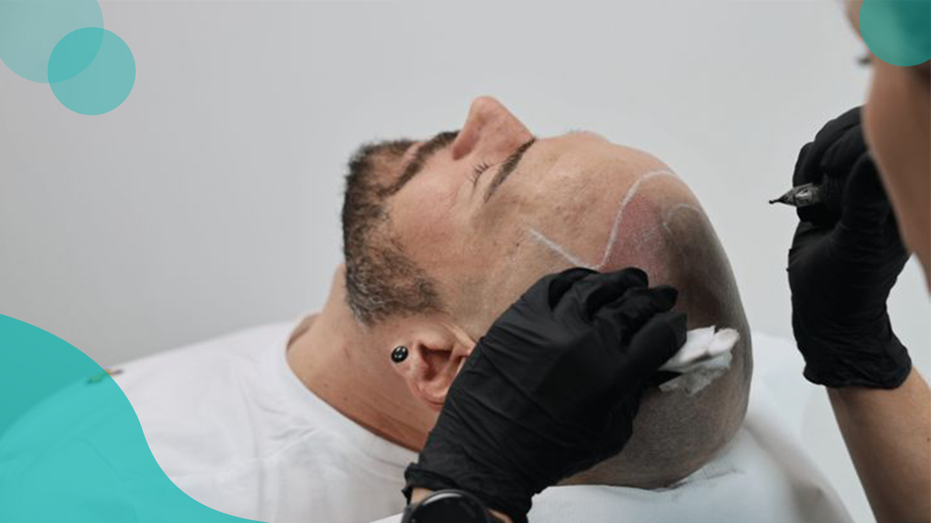 Cost of hair transplantation in Kabul