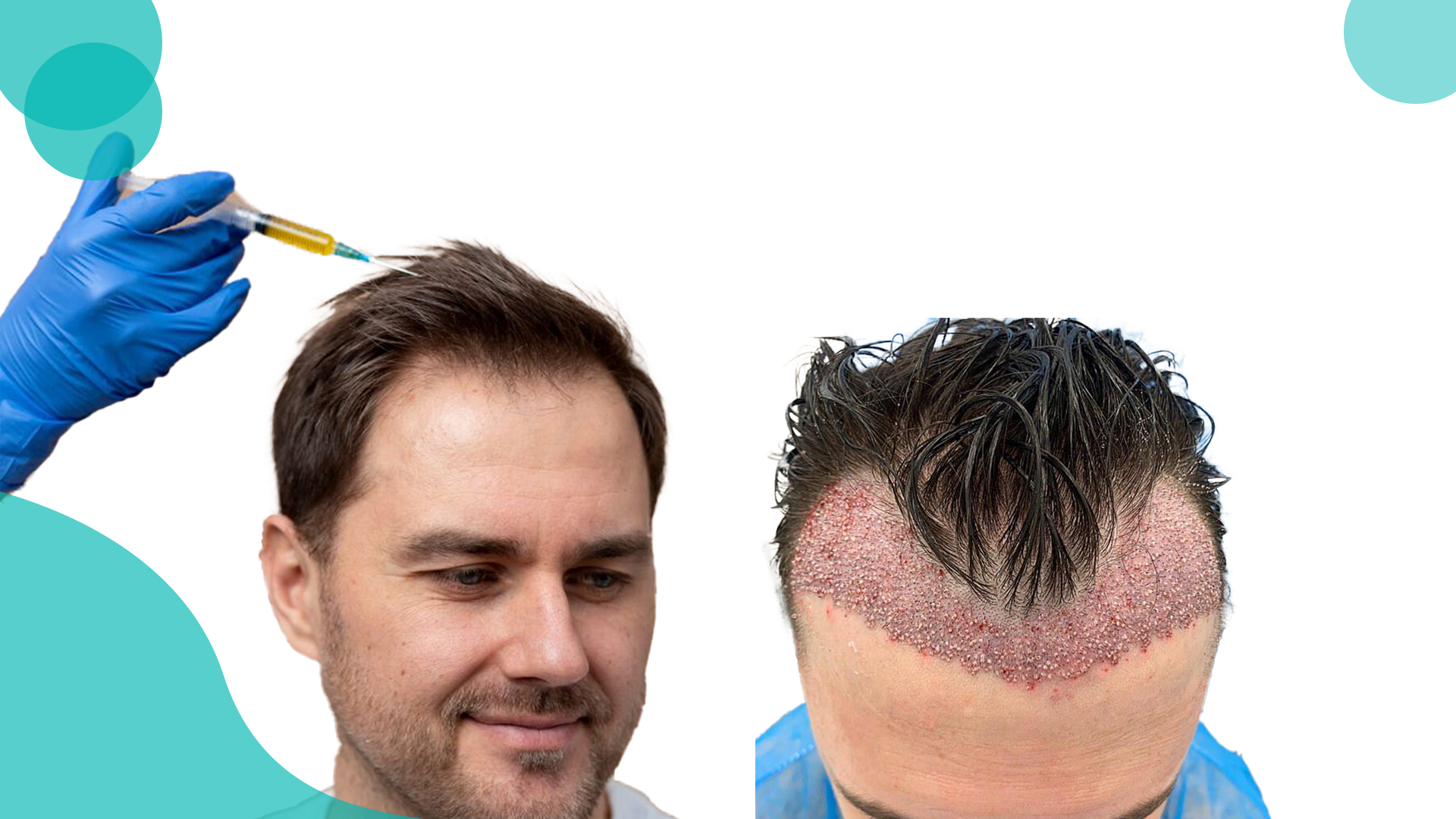 PRP or hair transplantation 
