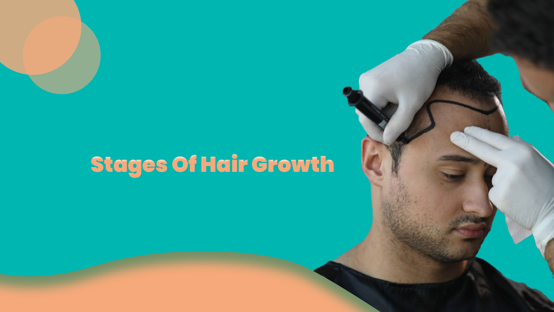 Stages of Hair Growth After a Hair Transplant