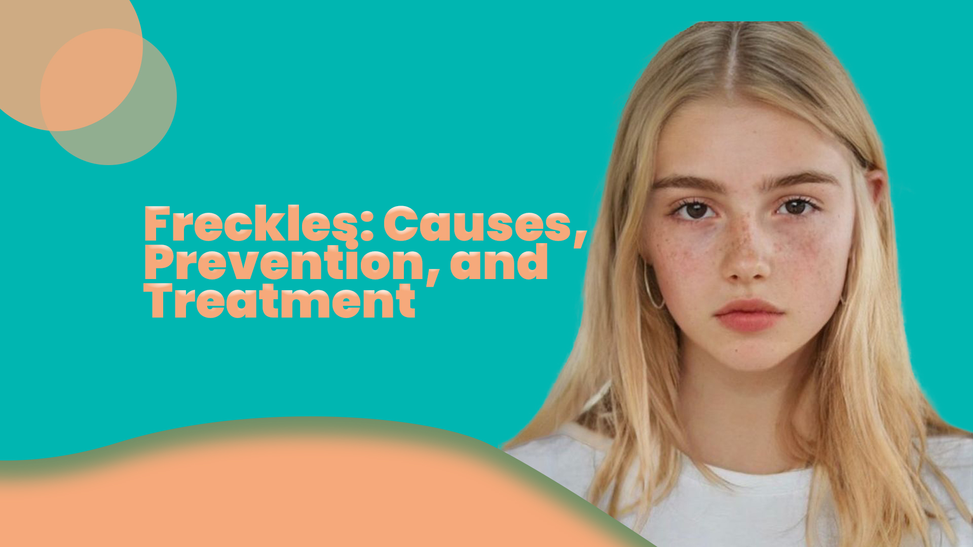 Freckles: Causes, Prevention, and Treatment