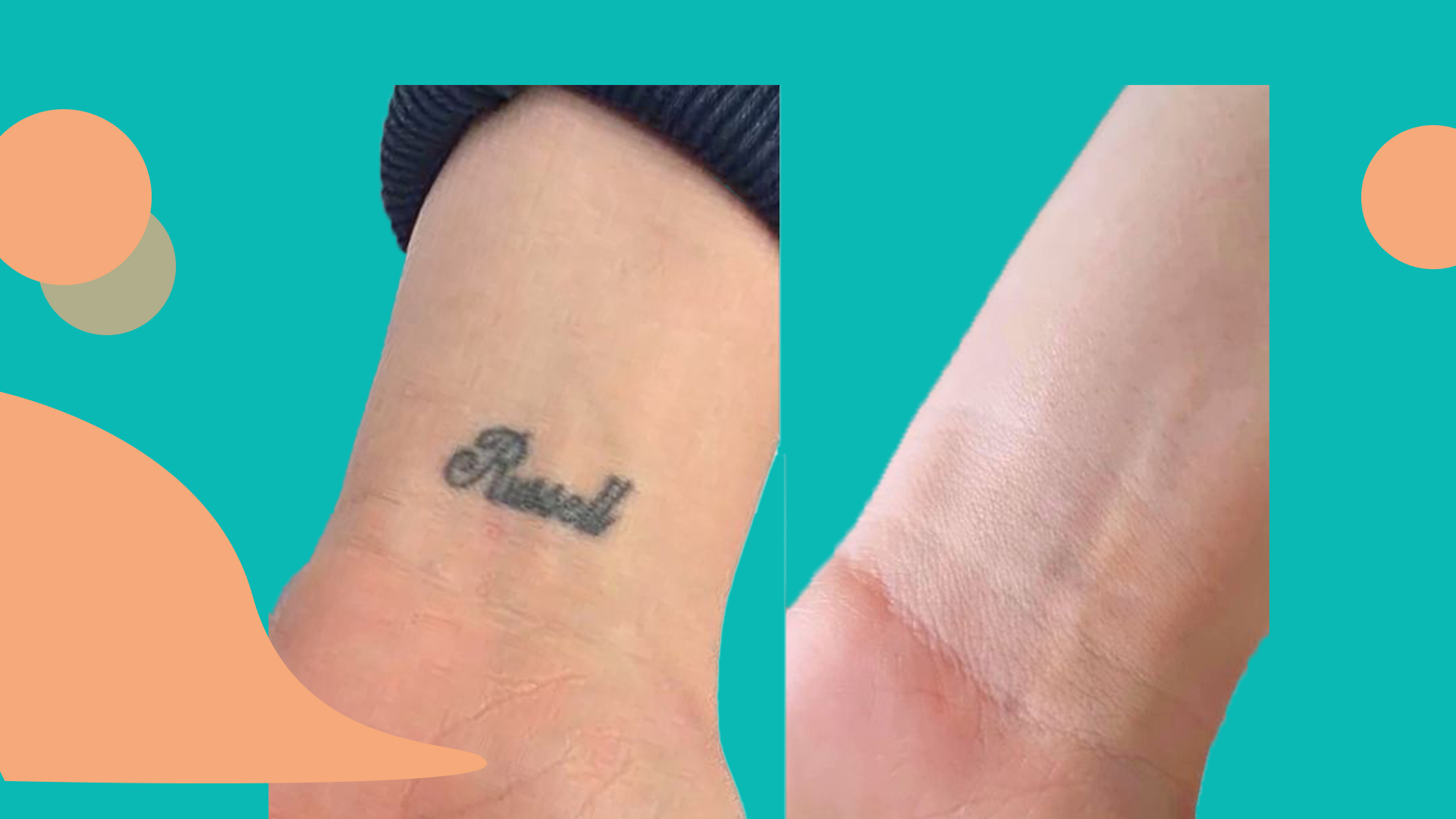 Tattoo Removal at Arvin Dermatology Hospital: Using Pico Laser, the Most Advanced Method for Tattoo Removal