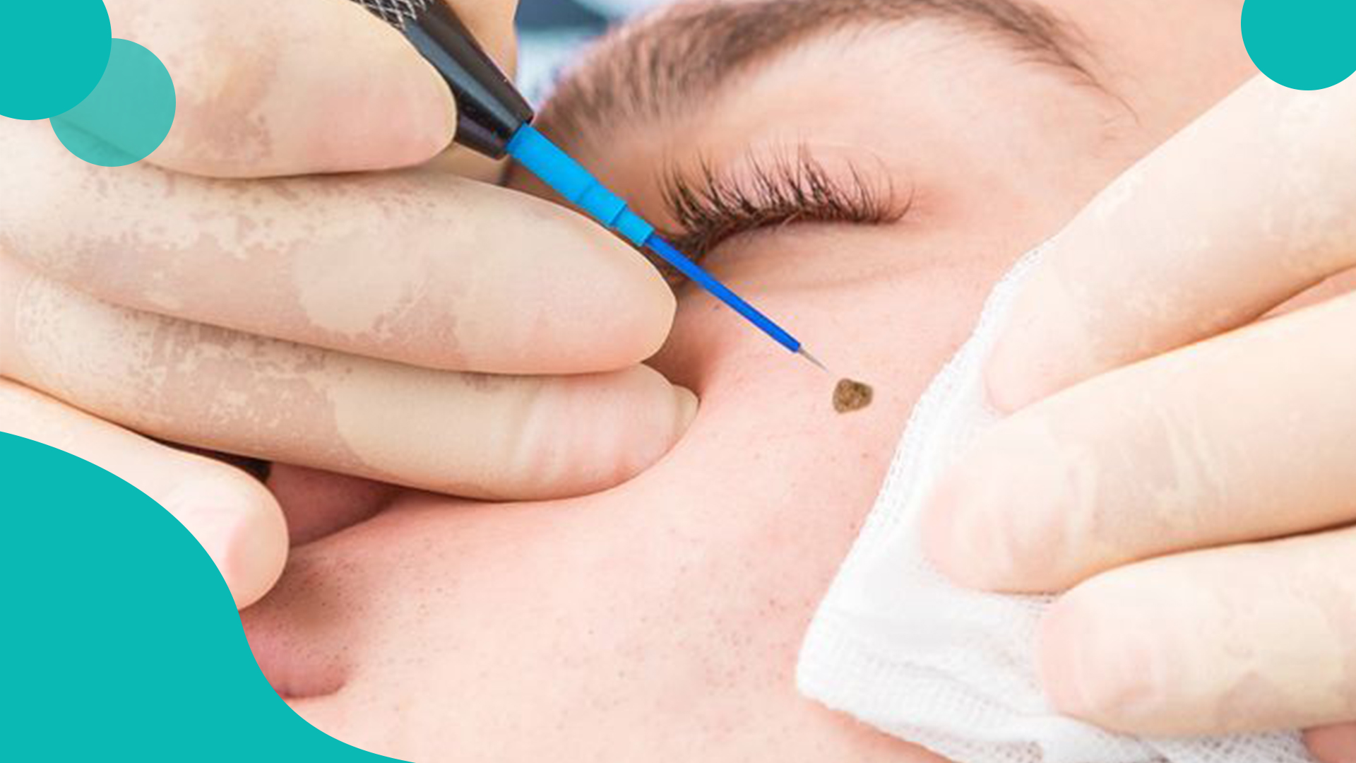 laser mole ( nevus) removal 
