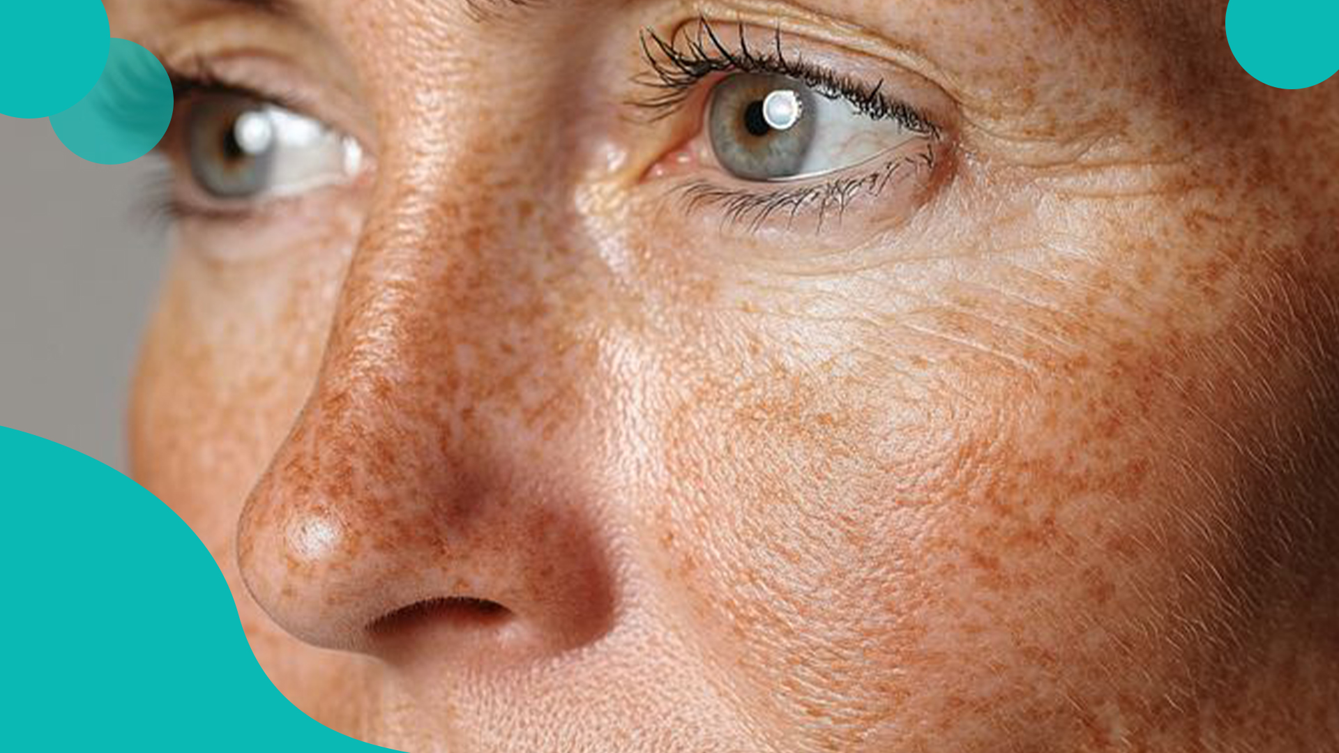 Melasma Treatment at Arvin Skin Hospital – Achieve Clear, Glowing Skin