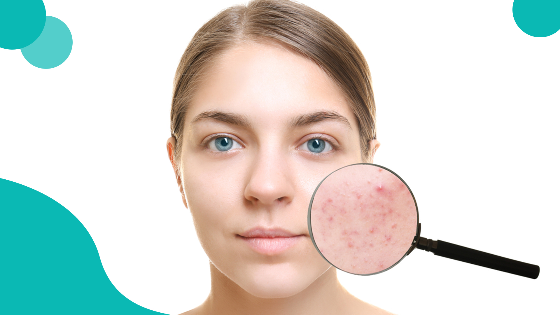 Treatment of acne in Kabul