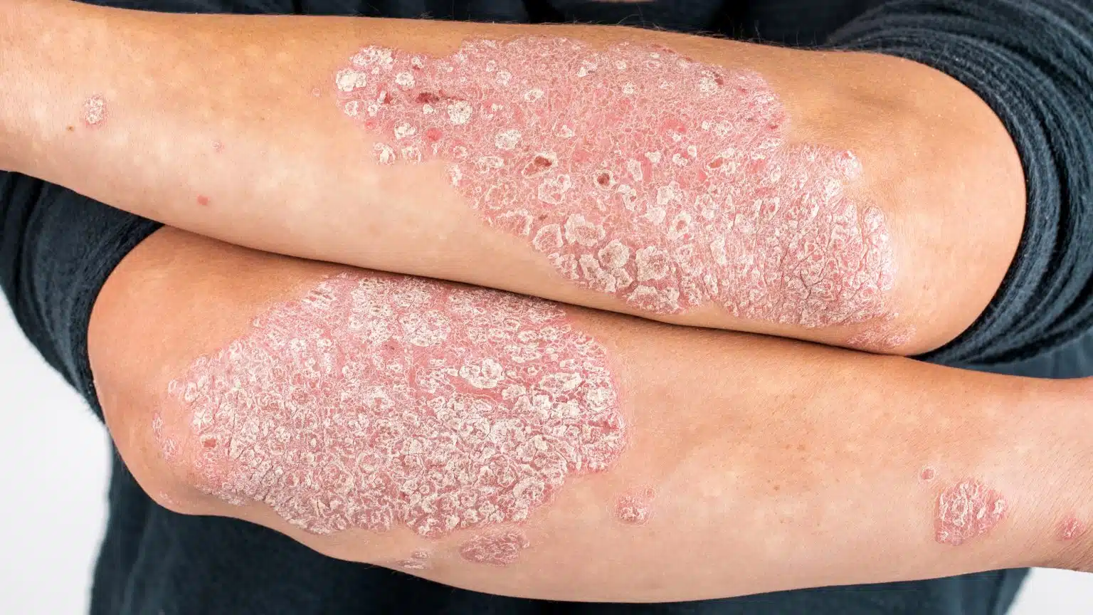 Psoriasis – Symptoms, Causes