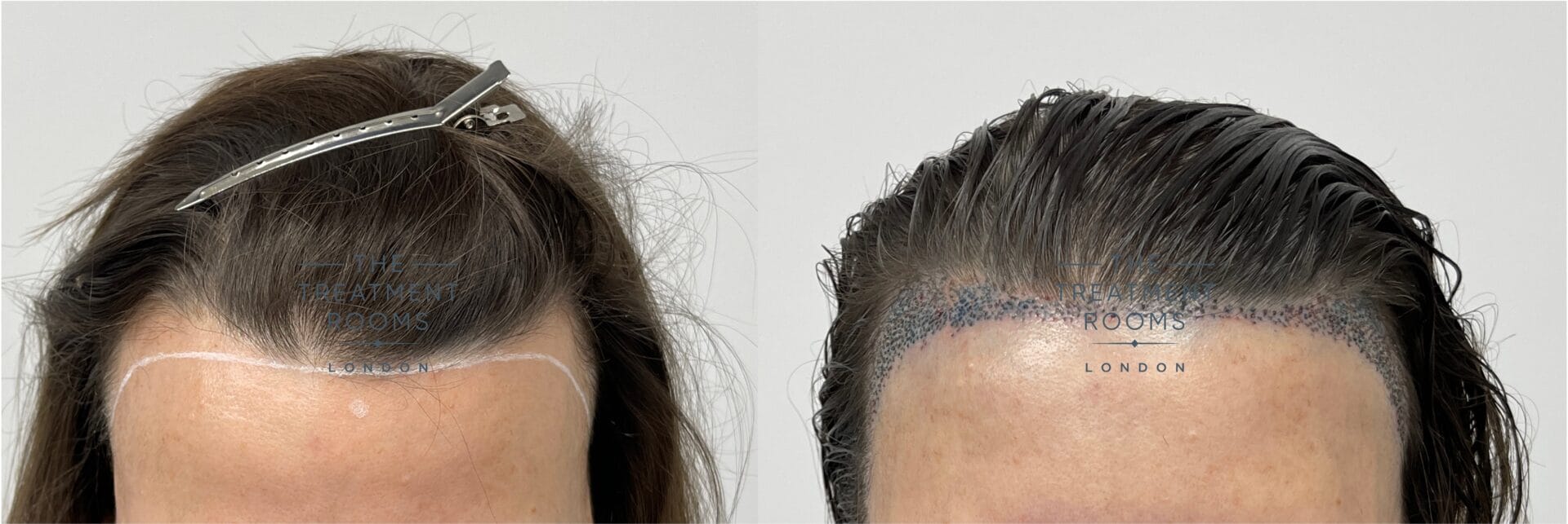 HAIR TRANSPLANTATION IN WOMAN 